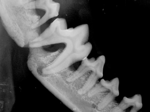 jaw bone fracture